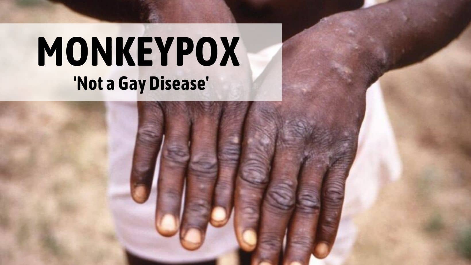 Monkeypox Not A Gay Disease, Anybody Can Contract It...: WHO Answers Vital Questions On The Virus